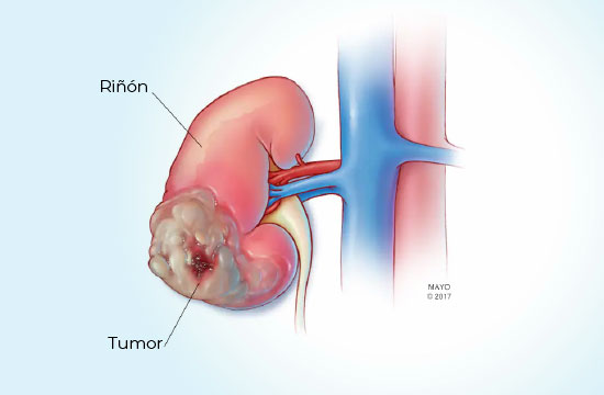 cancer-de-rinon-coi-img1