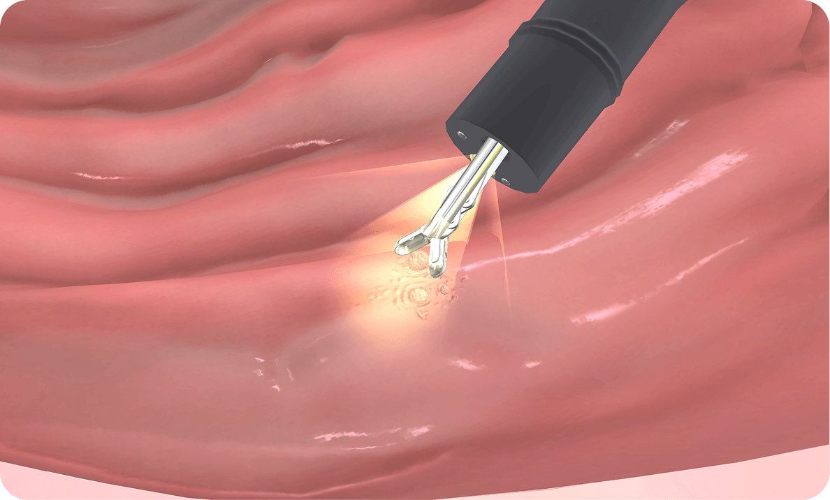 cirugia-oncologica-que-es-cirugia