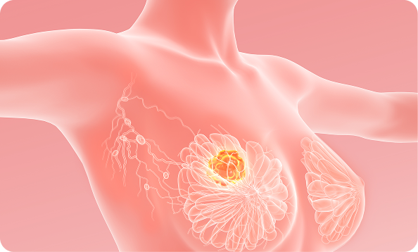 intro-tratamiento-para-el-cancer-de-mama